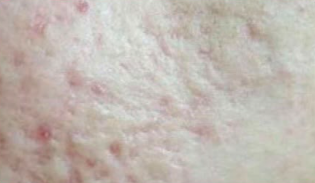 Antes do laser de CO2 - cicatriz de acne caso 1