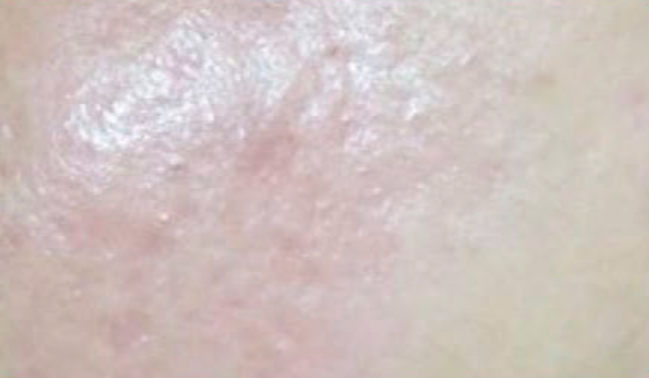Depois do laser de CO2 - cicatriz de acne caso 1