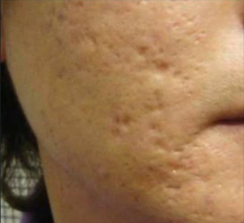 Antes do laser de CO2 - cicatriz de acne caso 2