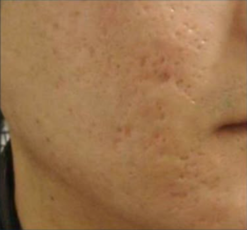 Depois do laser de CO2 - cicatriz de acne caso 2