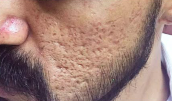 Antes do laser de CO2 - cicatriz