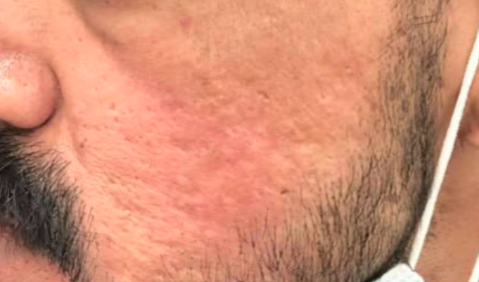 Depois do laser de CO2 - cicatriz