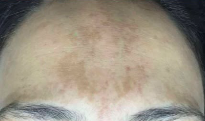 Antes do laser de CO2 - melasma