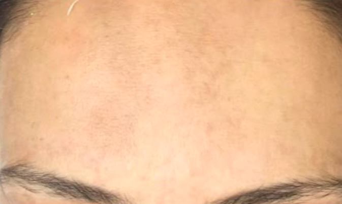 Depois do laser de CO2 - melasma