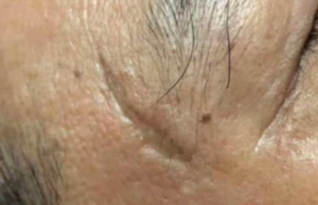 Antes do laser de CO2 - cicatriz traumática
