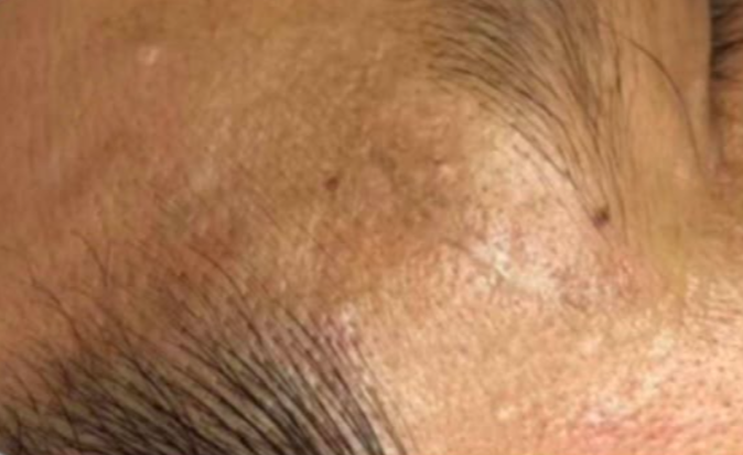 Depois do laser de CO2 - cicatriz traumática