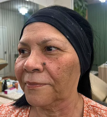 Antes do gerenciamento de pele - caso 1