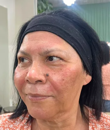 Depois do gerenciamento de pele - caso 1
