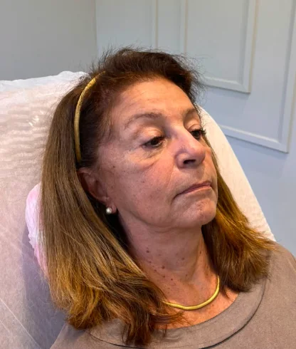 Antes da harmonização facial