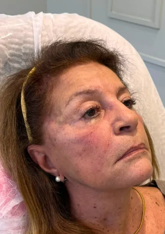 Depois da harmonização facial