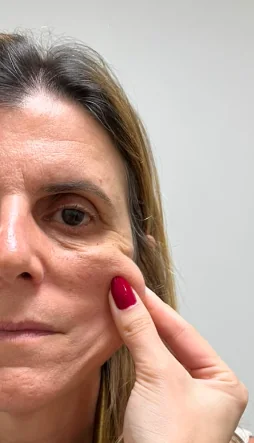 Antes do ultrassom micro e macrofocado - caso 1