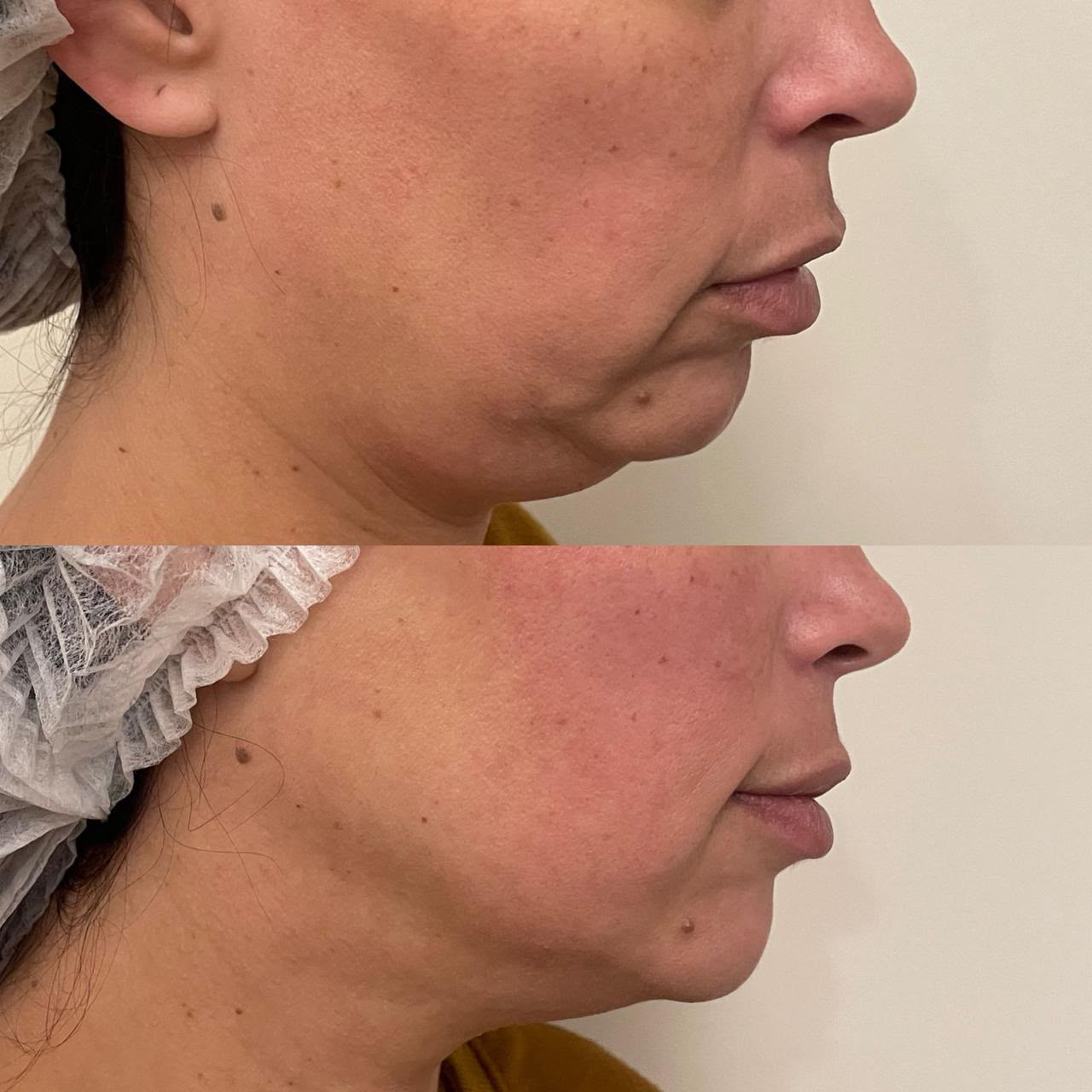 Resultado do ultrassom micro e macrofocado - caso 2
